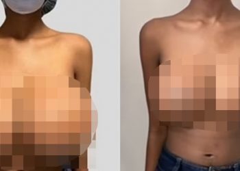 “코로나 백신 맞고 가슴 4배”…한국 웹툰 작가도 겪었다는데, 진짜 부작용?