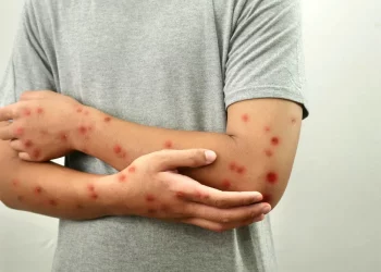 텍사스 홍역 확산… 백신 미접종 아동 첫 사망