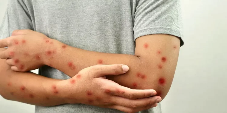 텍사스 홍역 확산… 백신 미접종 아동 첫 사망