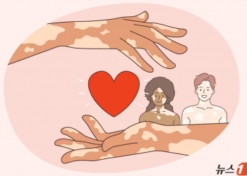 [100세건강] 군데군데 흰 반점 ‘백반증’…”불치병? 치료법 개발”