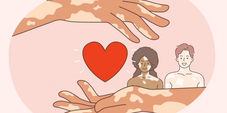 [100세건강] 군데군데 흰 반점 ‘백반증’…”불치병? 치료법 개발”