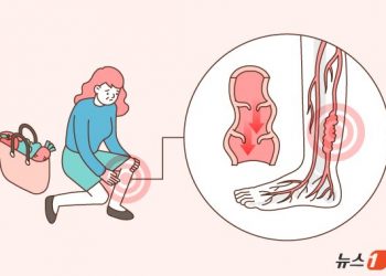 [100세건강] 퉁퉁 붓고 쥐 나는 ‘이 병’…”직립 보행 필연적 결과”