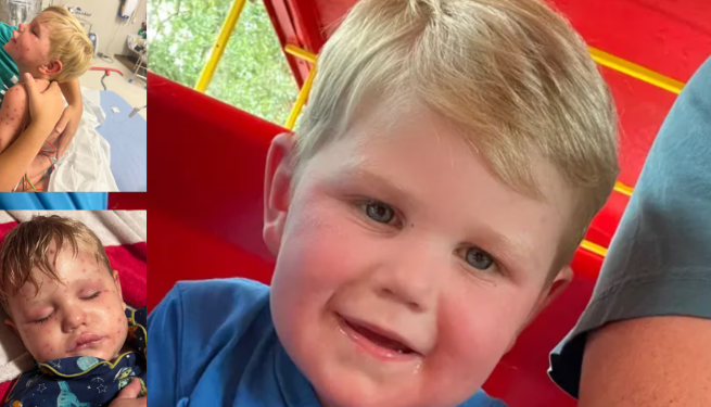 2살 조지아 남아, 말벌 150마리 이상에 쏘여 중환자실 이송