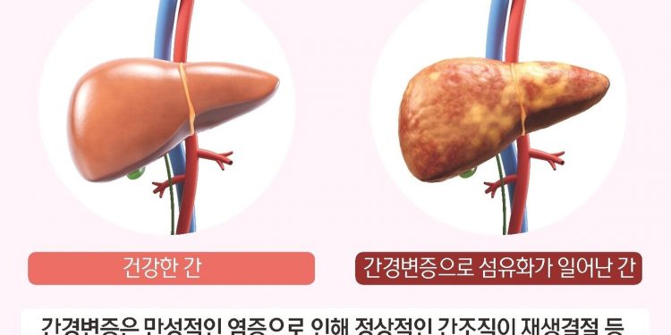 [100세건강] “70% 망가져도 모른다”…간경변증이 보내는 경고